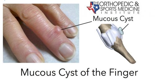 mucous cyst finger icd 10