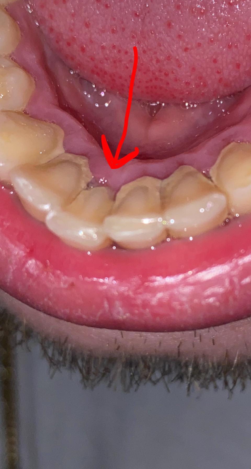 how to remove tartar from teeth without dentist reddit