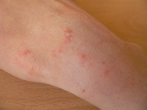 does vinegar kill scabies