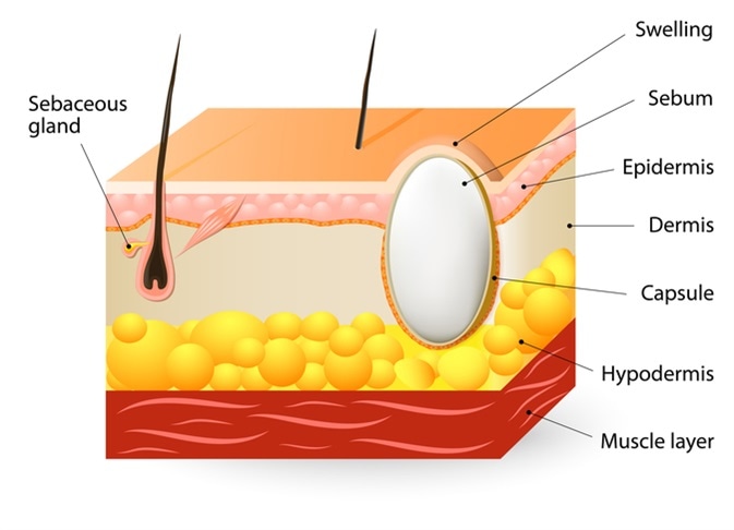 pilar cyst diagram