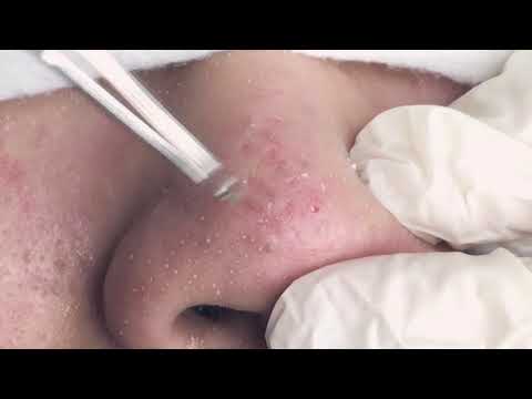 bubuplus blackhead removal 2018