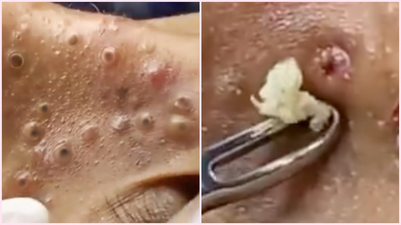 blackheads popped