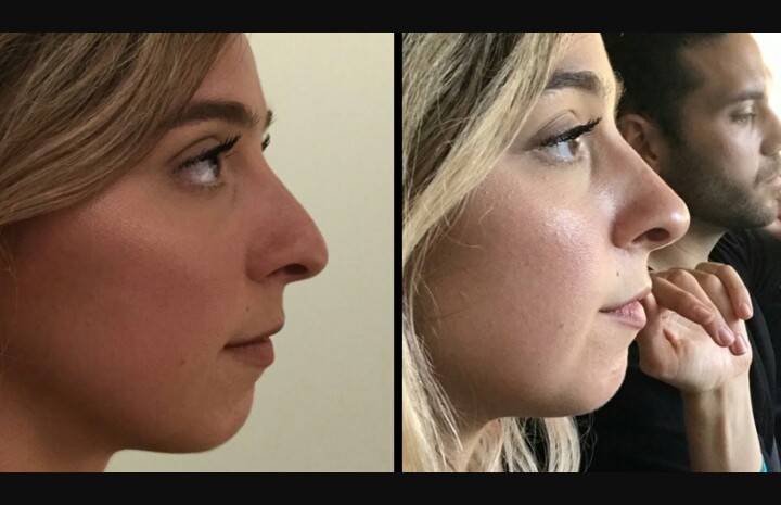 gabbie hanna nose