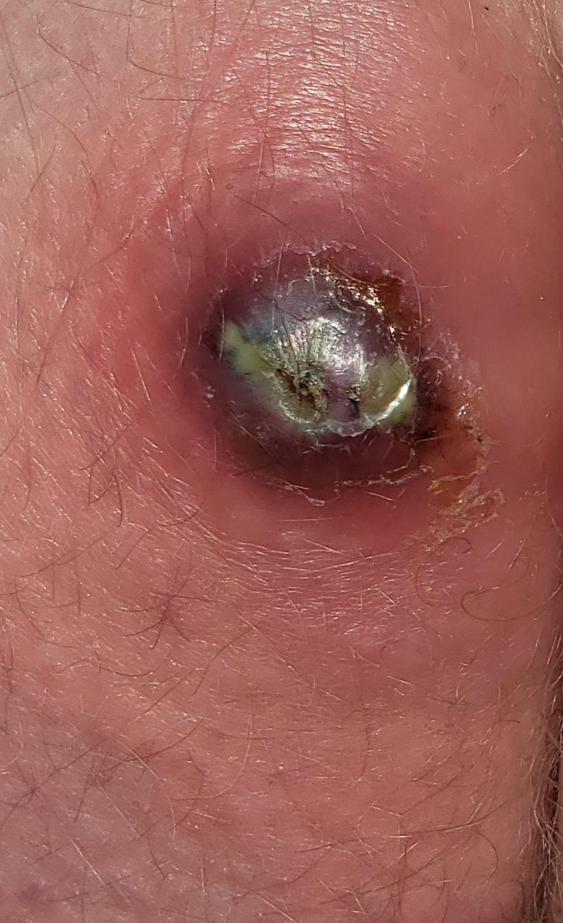 popped pilonidal cyst