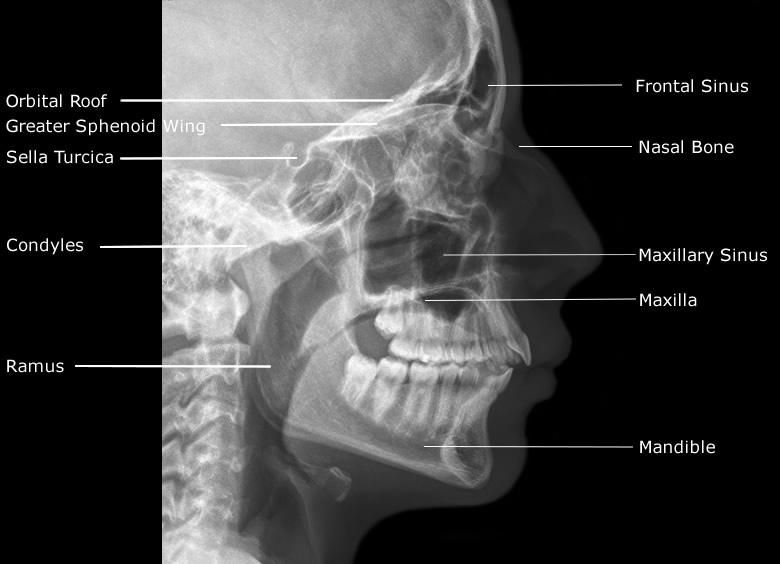 mandible anatomy radiology