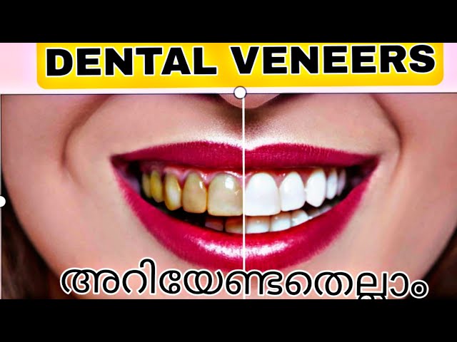 veneer meaning in malayalam