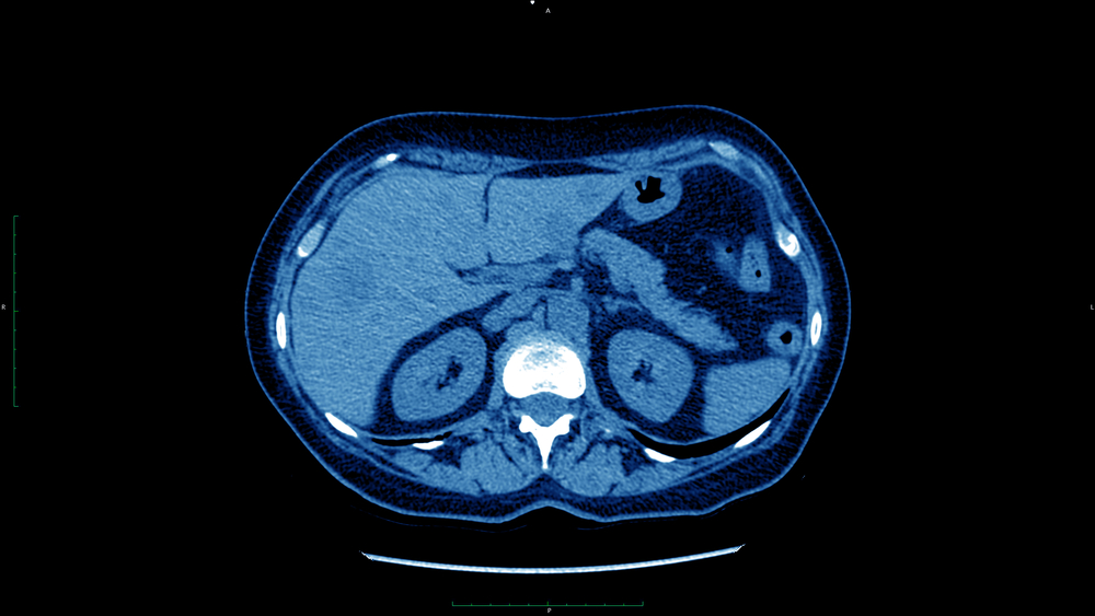 focal nodular hyperplasia liver