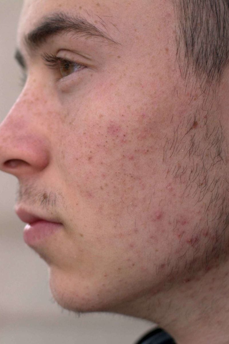 does masturbating give you acne