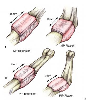 intrinsic plus deformity