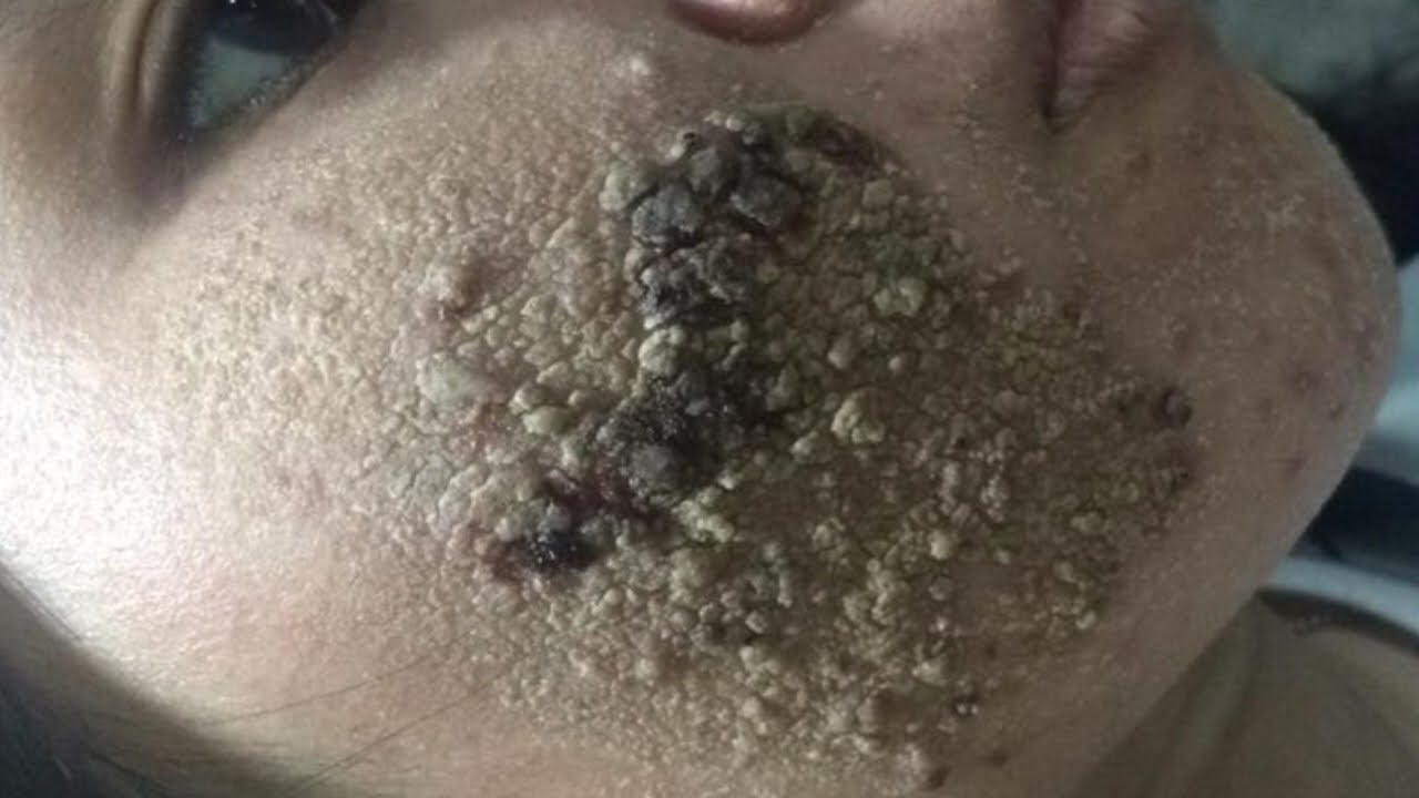 severe cystic acne popping