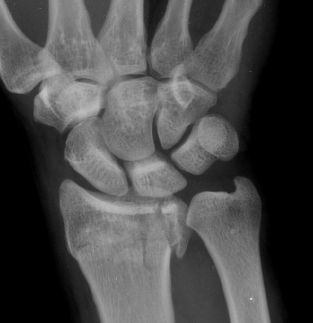 distal radius fracture radiopaedia