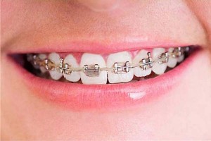 imagenes de brackets bonitos