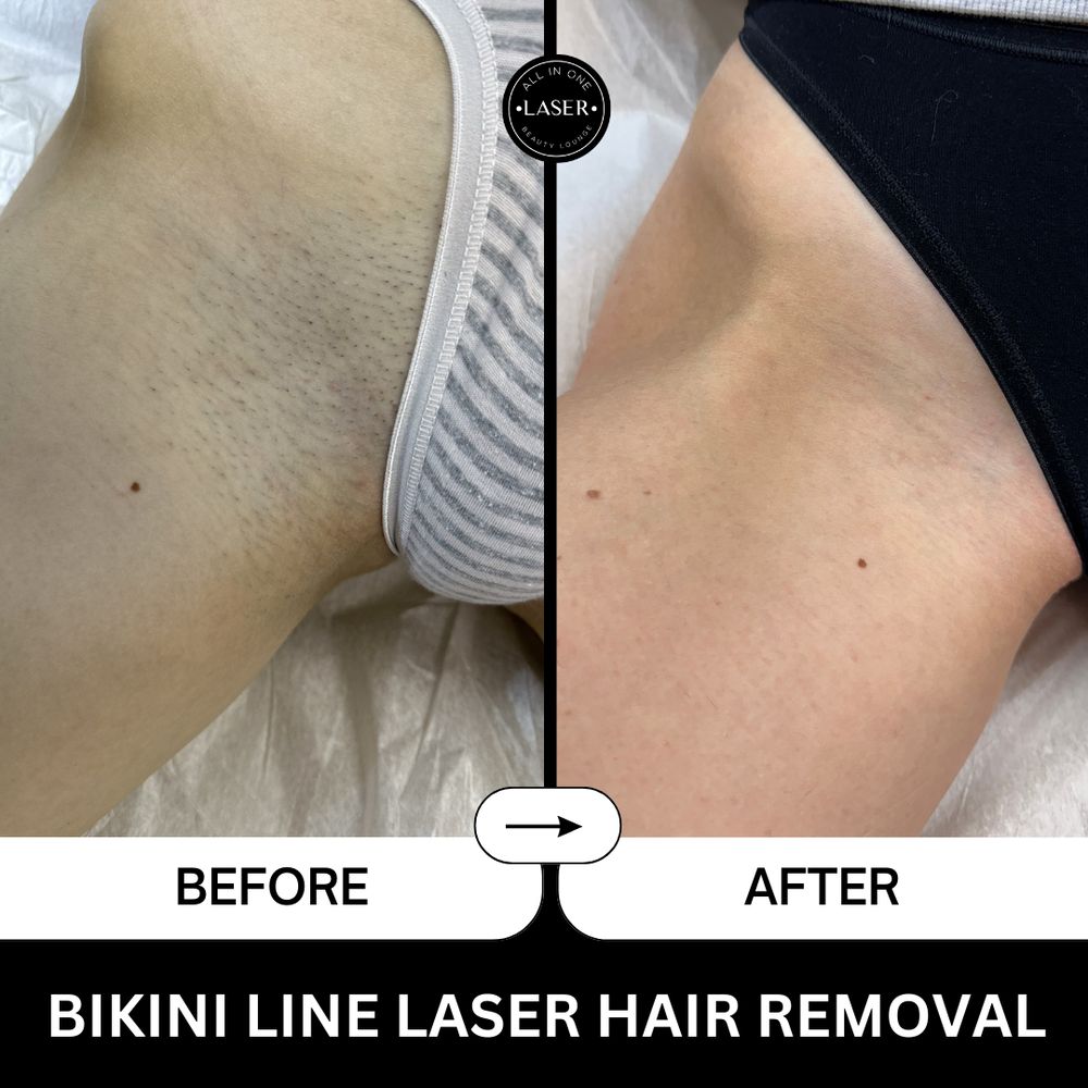 laser hair removal belmont