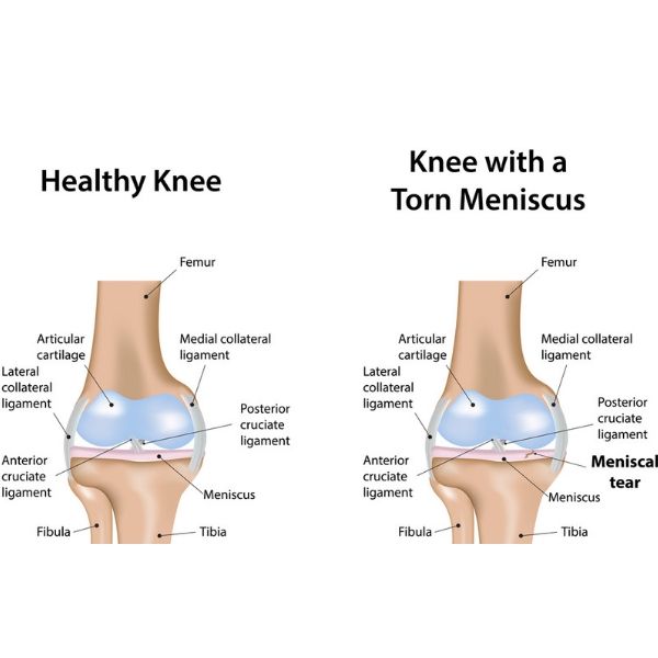 torn meniscus icd 10