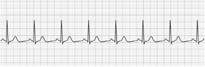 acls ecg rhythms