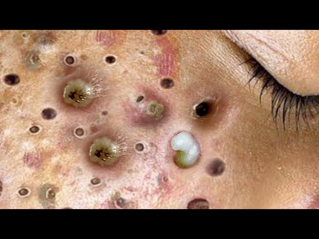 blackhead removal videos