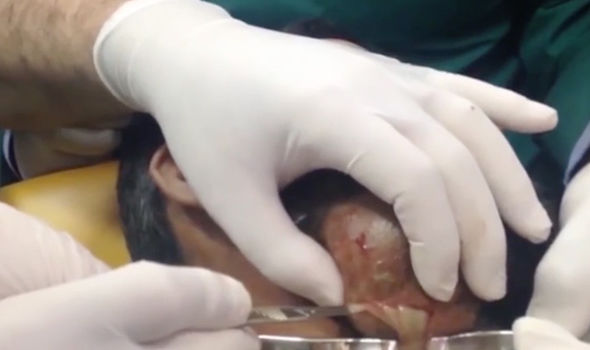 biggest cyst explosion ever seen