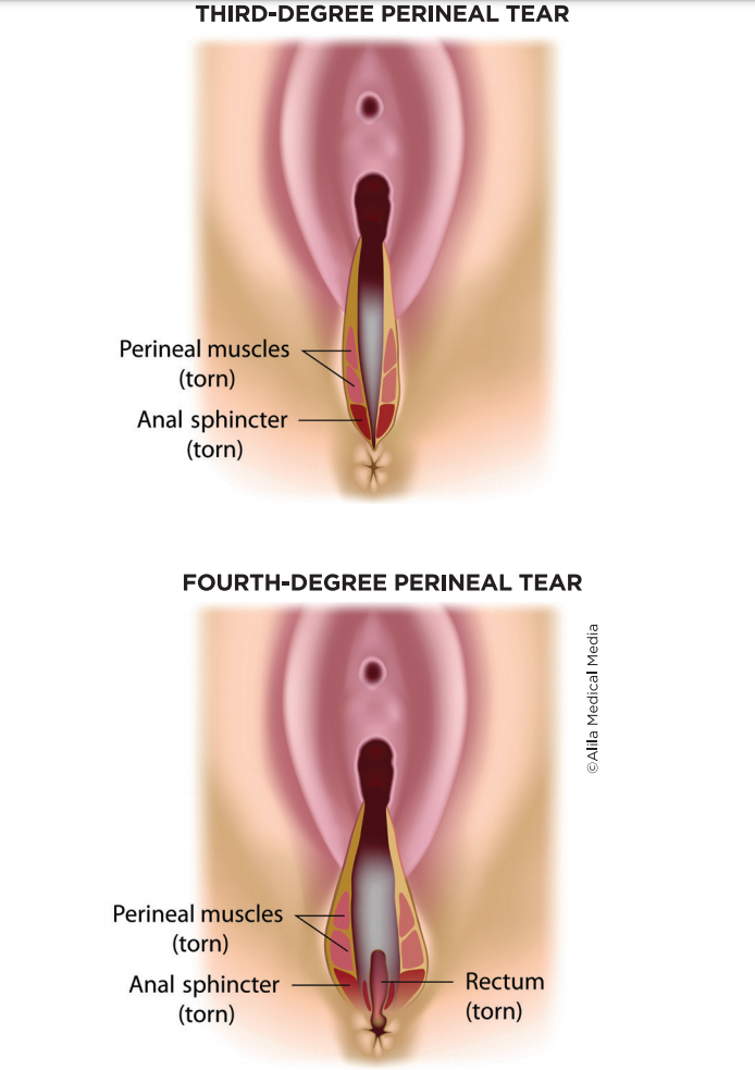 3rd degree perineal tear pictures