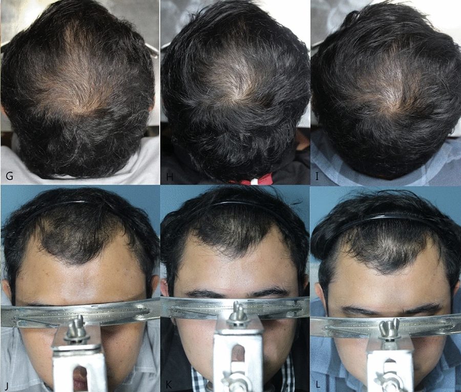 medoxomil hair