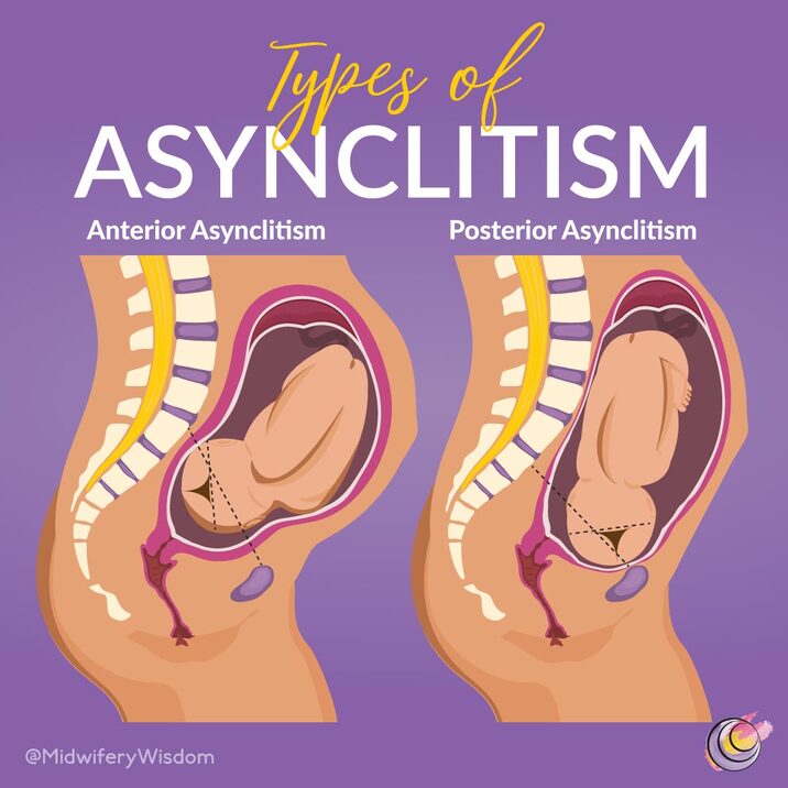 asynclitism meaning