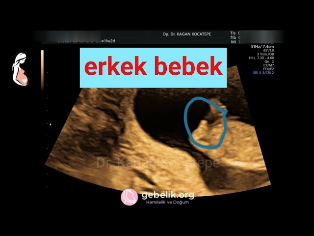 erkek bebek ultrasonda nasil durur