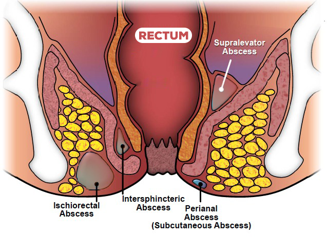 perianal abscess icd