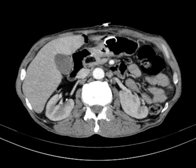 lipoma on pancreas