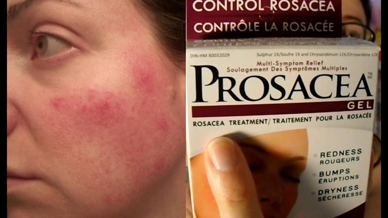 prosacea reviews for rosacea