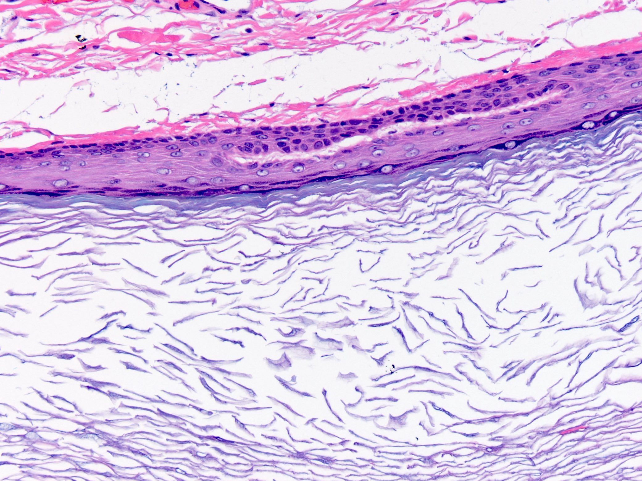 epidermoid cyst pathology outlines