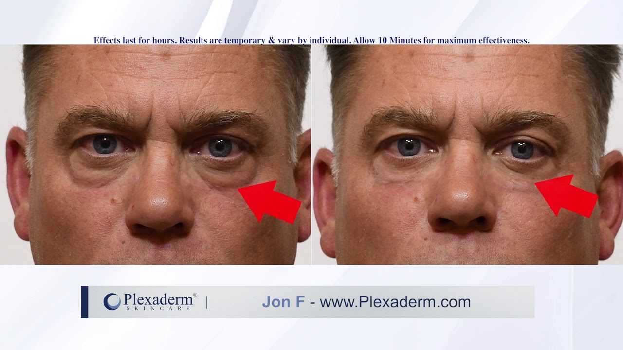 plexaderm reviews