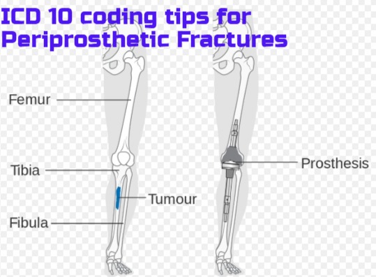 tibia fibula fracture icd 10