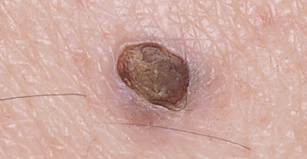 dilated pore of winer