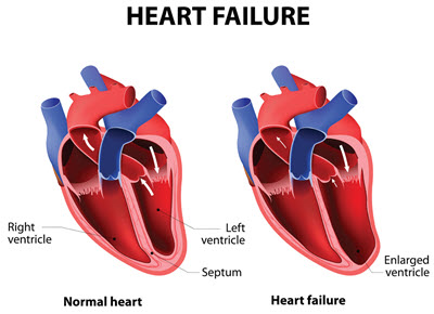 hfref icd 10