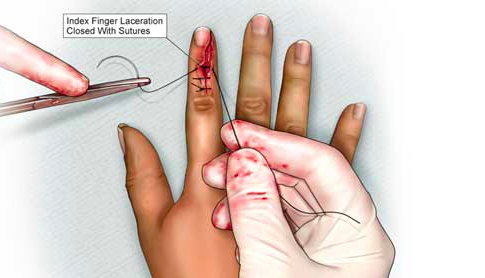 laceration left thumb icd 10