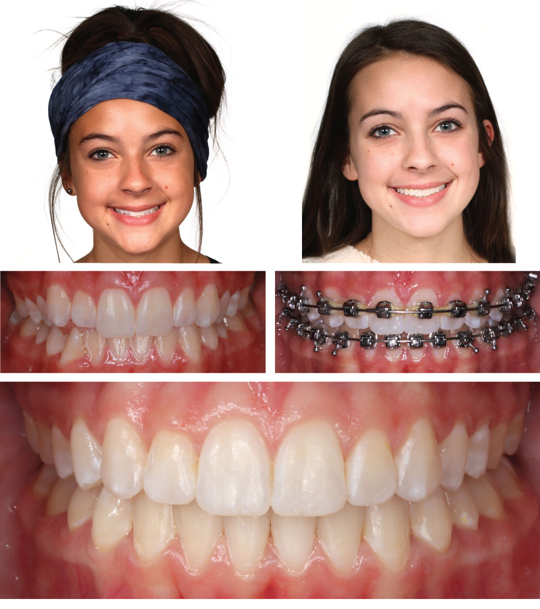 how much do braces cost in kansas city