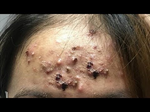 worst blackheads removal