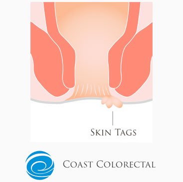 anal skin tag removal melbourne