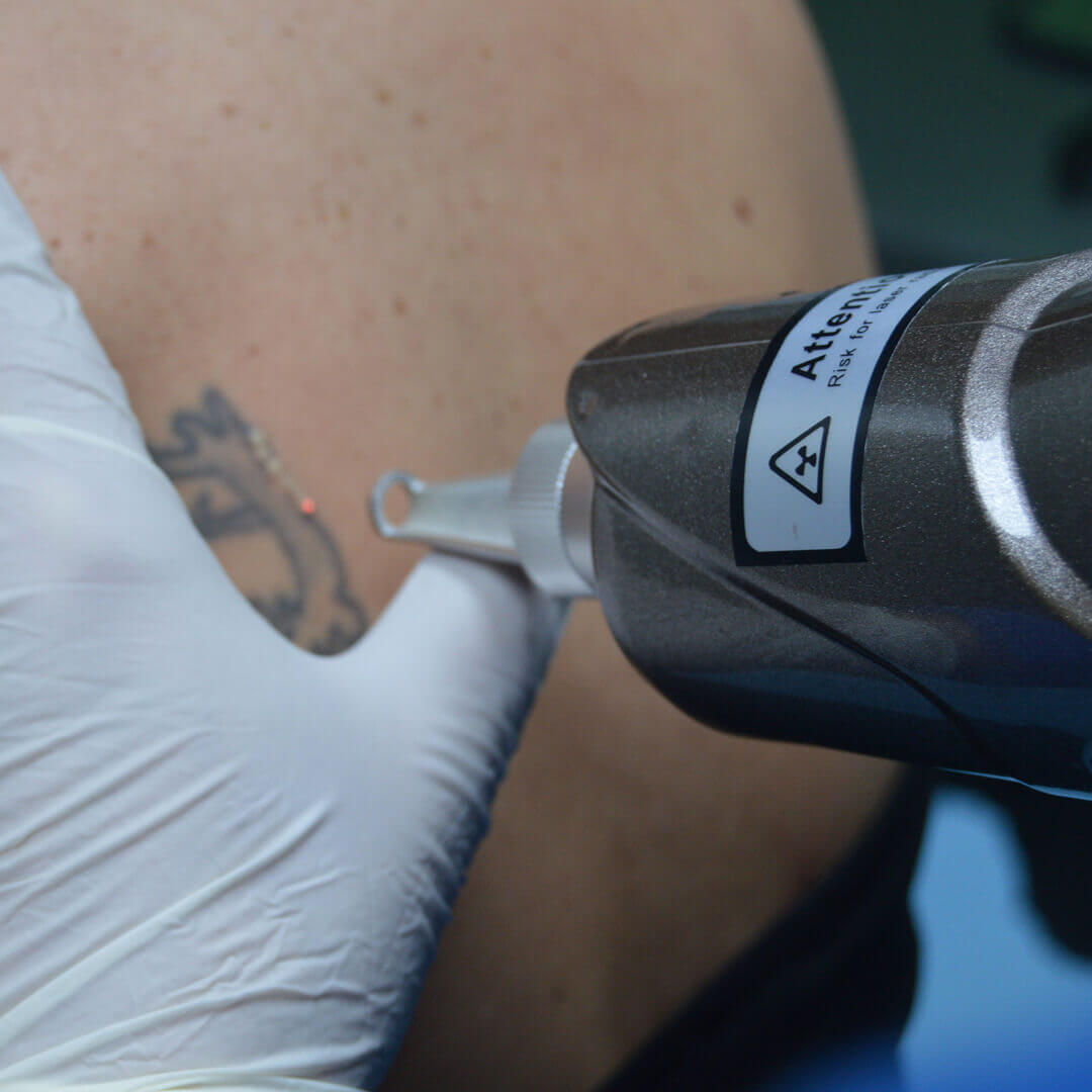 tattoo removal madrid