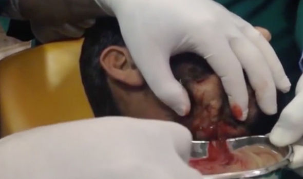 biggest cyst pop