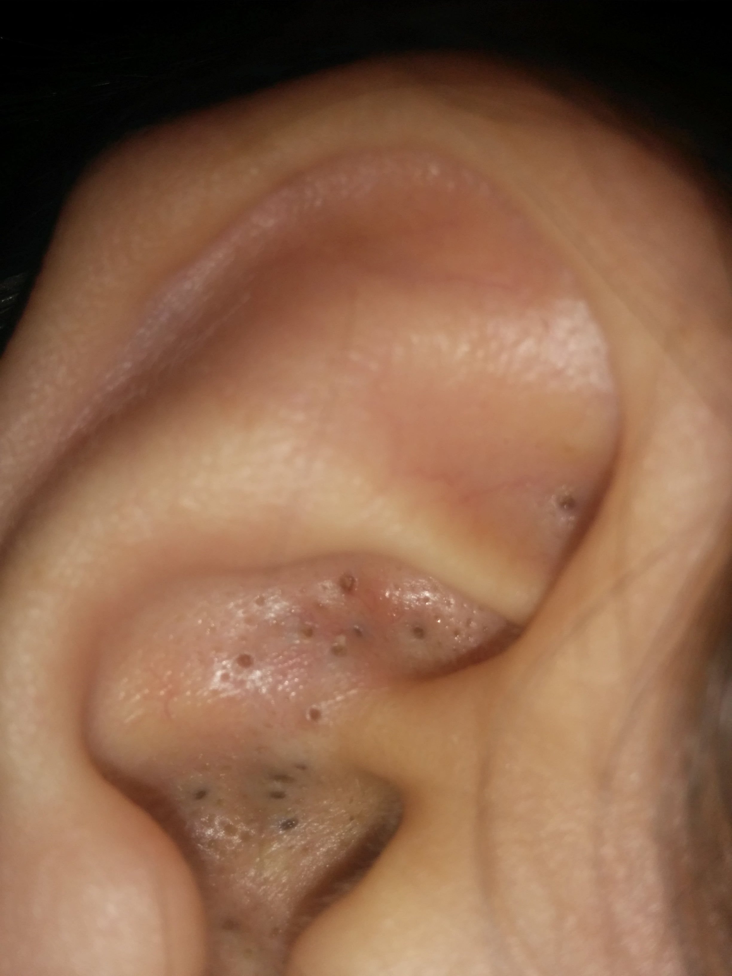 blackheads inside ear