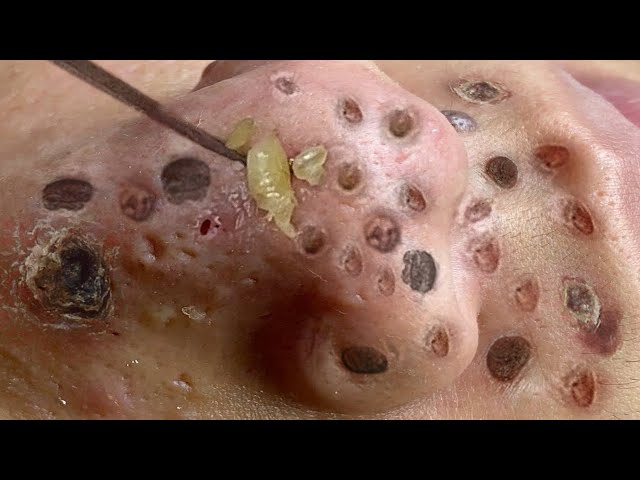 blackheads removal youtube