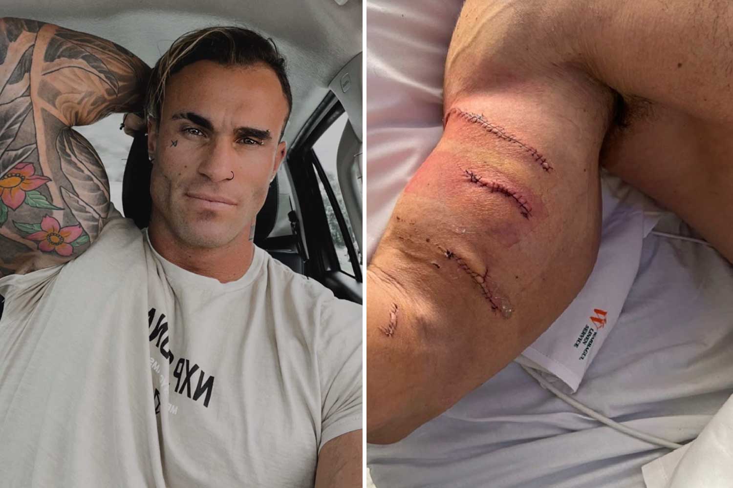 calum von moger injury