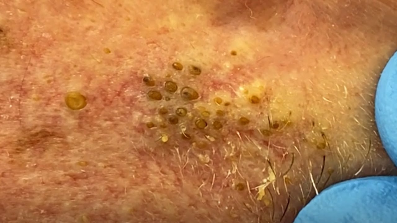 blackheads youtube