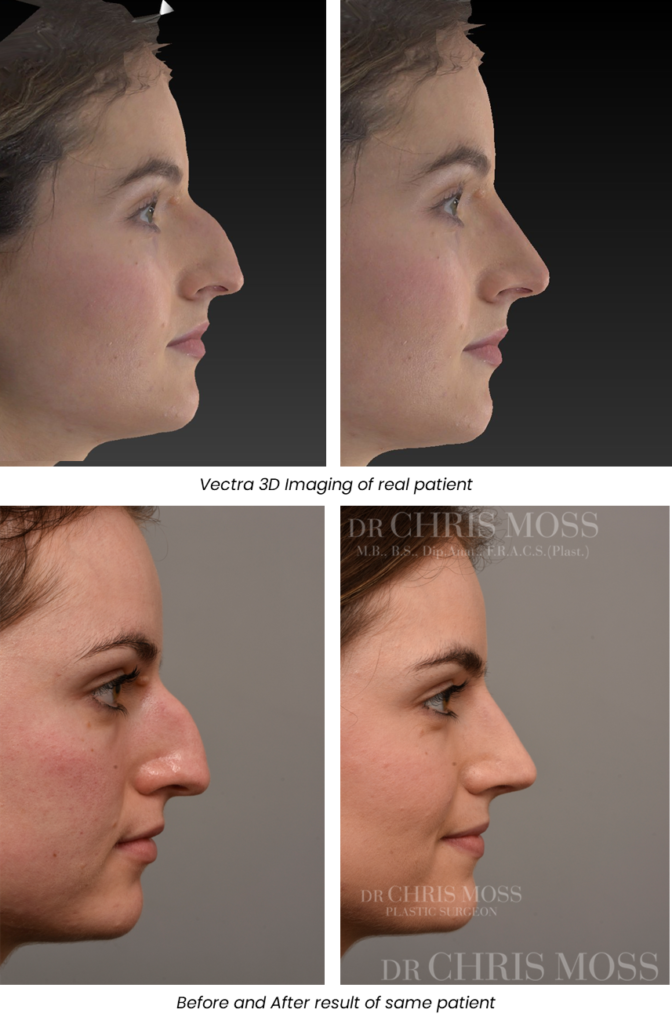 cheap rhinoplasty australia