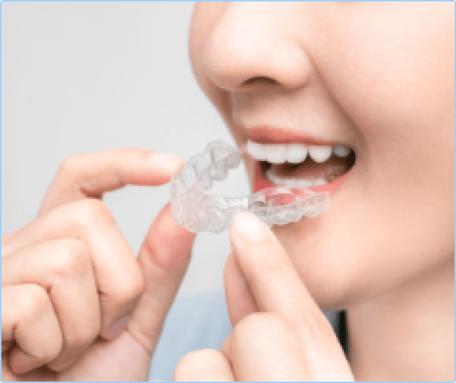 dental bleaching richmond bc