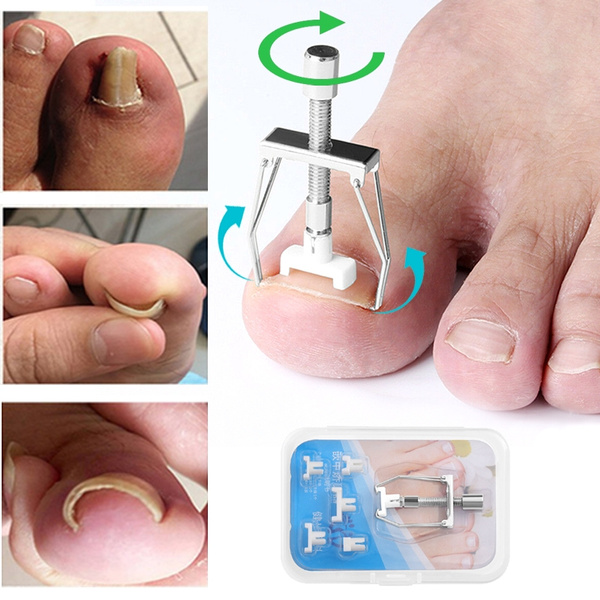 ingrown toenail tool