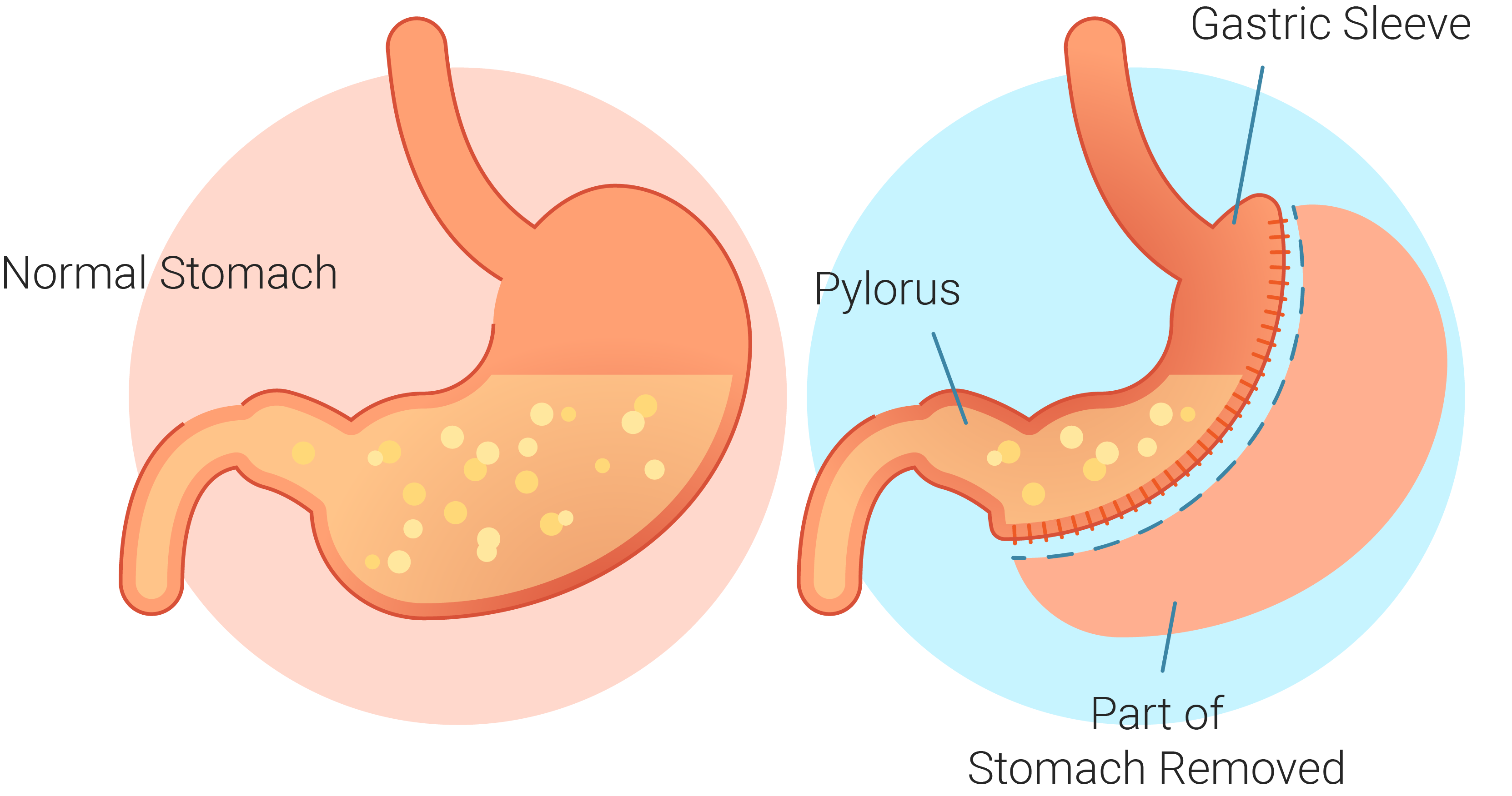 gastric sleeve surgery perth