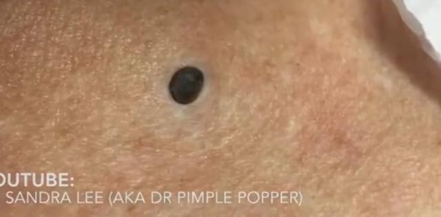 huge blackheads popped