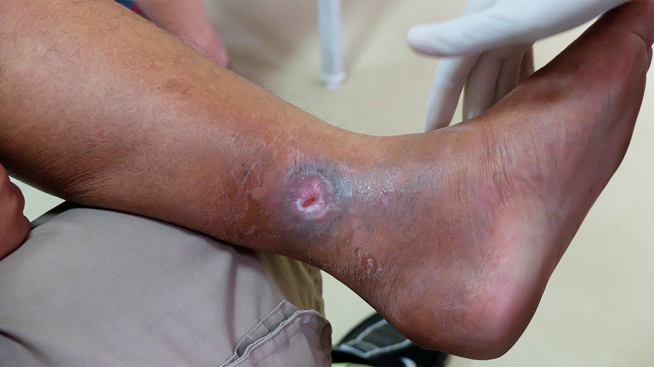 icd 10 venous stasis ulcer right lower leg