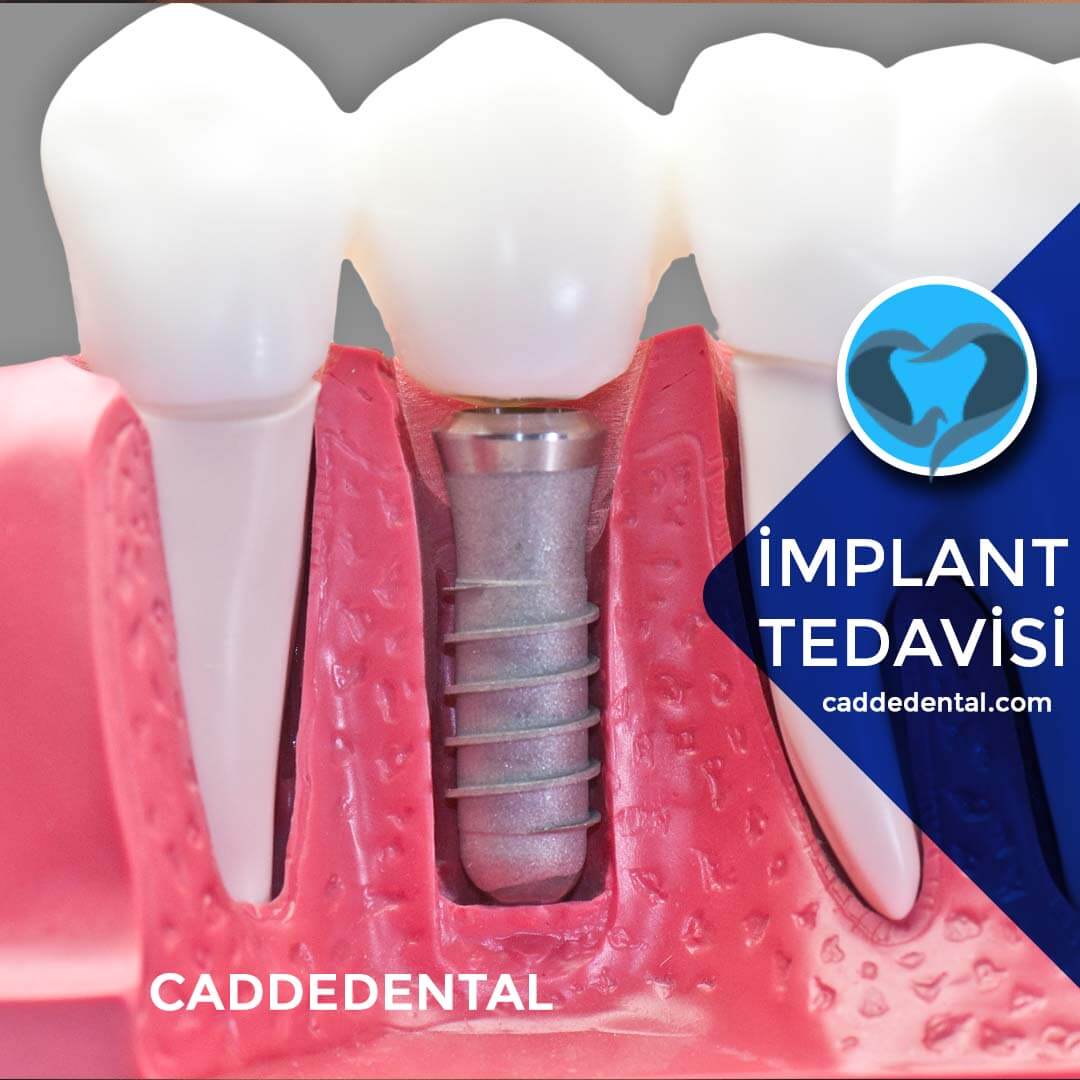 implant fiyatları 2019 izmir